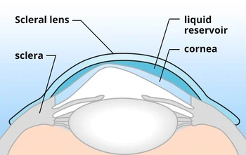 Scleral lenses in Cambridge, ON